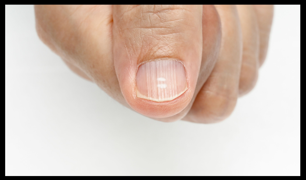 Nail Changes