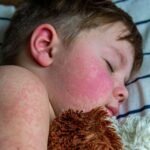 U.S. Measles Outbreaks underscore Vaccination Importance