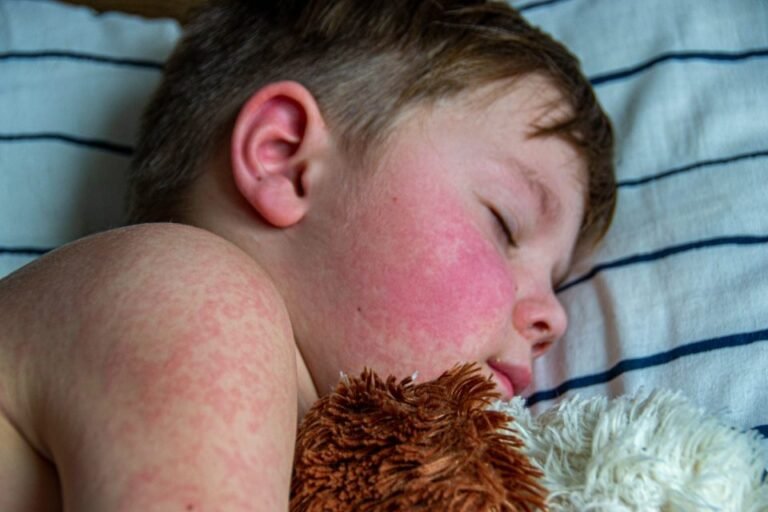 U.S. Measles Outbreaks underscore Vaccination Importance