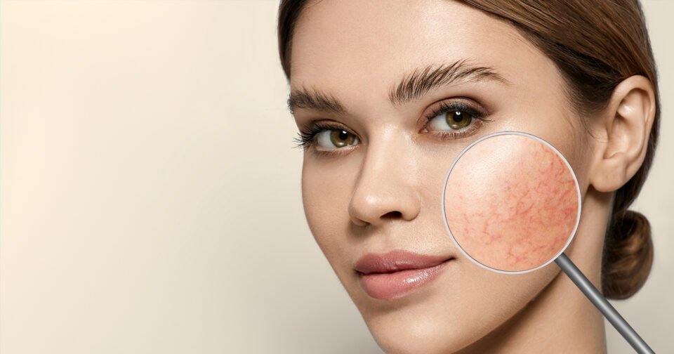 The Role of Skin Care in Rosacea Treatment